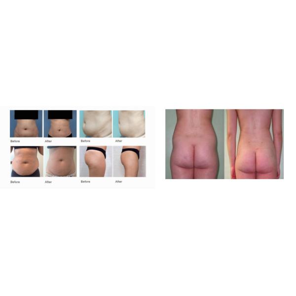 White Tender Skin Portable Cryolipolysis Machine , Vertical Fat Slimming Machine