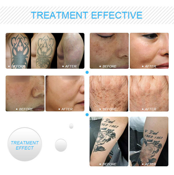 2mm To 10mm Pico Laser Tattoo Removal Machine Commercial