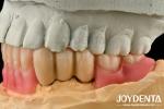 Stainless Steel Prostheses Partial Dentures Attachments Polished Surface Ball