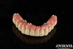 Wholesale Dental Titanium Malo Implant Bridge Combining Traditional And Modern Techniques from china suppliers