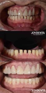 Wholesale Nature Shape Cosmetic Dentistry Porcelain Veneers , Dental Cosmetic Porcelain Veneers from china suppliers