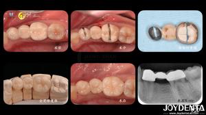 Wholesale Tailored Dental Zirconia Crown Biocompatibility Comfort Customization For Optimal Patient Experience from china suppliers