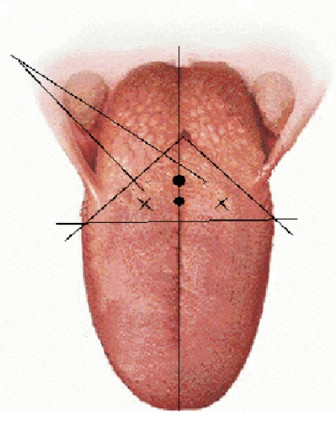 Low Temperature RF Plasma System Cutting Perforation Ablation Cryosurgery Unit