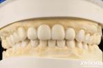 Dental Biomimetic Aesthetic Diagnostic Wax-Up Of Veneers