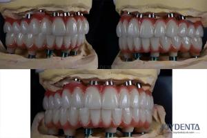 Wholesale 10mm Titanium Multiple Teeth Implant Rough Surface For Dental Restoration from china suppliers