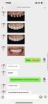 Excellent Biocompatibility Dental Porcelain Veneers No Need For Preparation