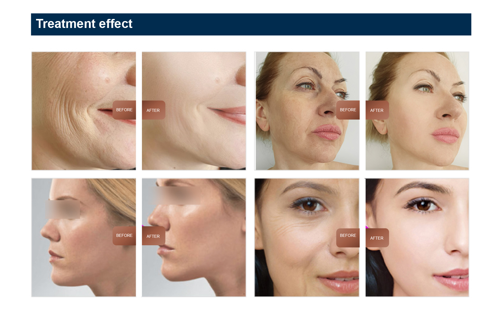 Advanced Desktop EMS RF Face Sculpting Machine for Skin Tightening and Wrinkle Removal