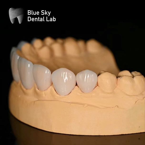 Ultra Thin Sleek Veneer Cases 0.3mm Thinnest Custom Veneers