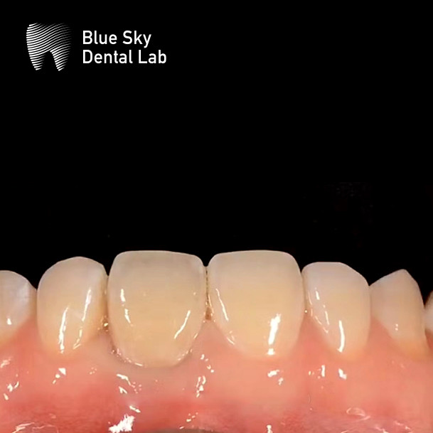 Layered Zirconia Implant Crown Zirconia Abutment Biocompatible