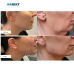 Professional 1470Nm 980Nm Laser Endolifting Machine Smart Light Anti-Aging