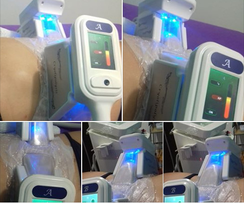 Cryolipolysis Ultrasound Cavitation RF Equipment Coolsculpting
