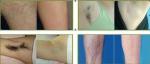 High Quality of Portable 808nm Diode Laser Hair Removal Machine Beauty Spa Hair