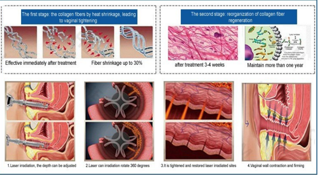 Dermatology Erbium Fractional CO2 Laser Machine Vaginal Skin Rejuvenation Laser Machine