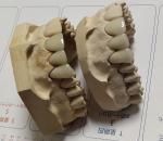 Porcelain CAD CAM PFM Crown