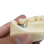 Ultra Hard Colour Stability OEM Dental Implant Crown Easy Maintain