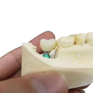Wholesale Redefining Aesthetics Our Natura Looking Dental Implant Crowns from china suppliers