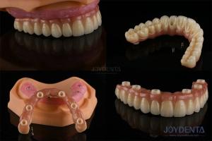 Wholesale Ivoclar Implant Ball Attachments Removable Dental Implant Material For Oral Hygiene from china suppliers