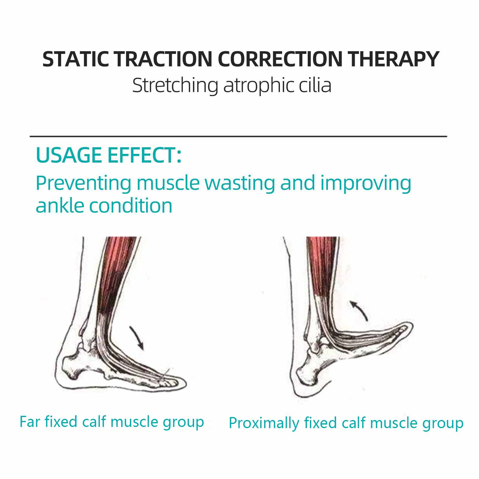 Ankle post-surgery hemiplegia stiffness foot drop dorsiflexion large angle exercise pulling tendon trainer