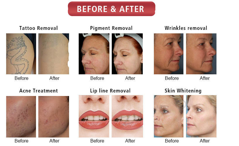 4IN1 IPL SHR OPT Nd Yag Laser Hair Removal Machine Skin Rejuvenation