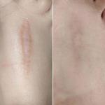 40w 60W Fractional CO2 Laser Machine For Wrinkle Removal Stretch Mark Scar