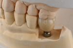 3.75mm Silver Titanium Screw Dental Implant Single Tooth Replacement Implant