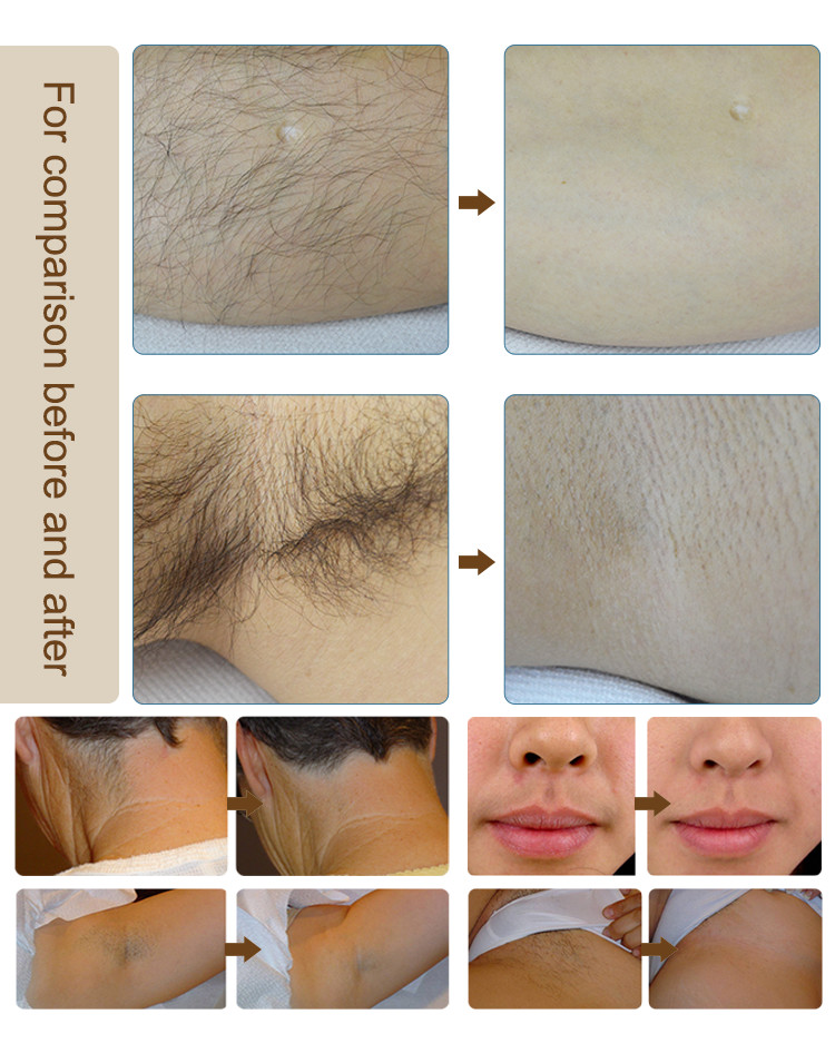 Alexandrite Laser Hair Removal Machine For All Hair Colors