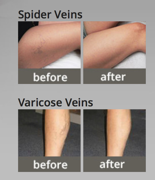 Free shipping!! blood vessels removal/portable spider vein removal machine