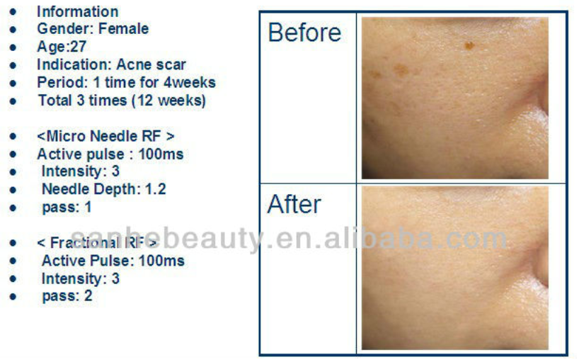 Portable face contour Micro needle rf fractional machine