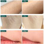 Titanium 755nm 1064nm Diode Laser Hair Removal Machine Laser Depilation Device 3