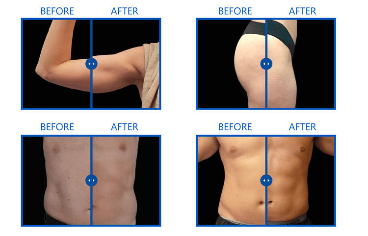4 Handpieces Tesla EM Sculpting Machine Fat Loss Hiemt Muscle Machine