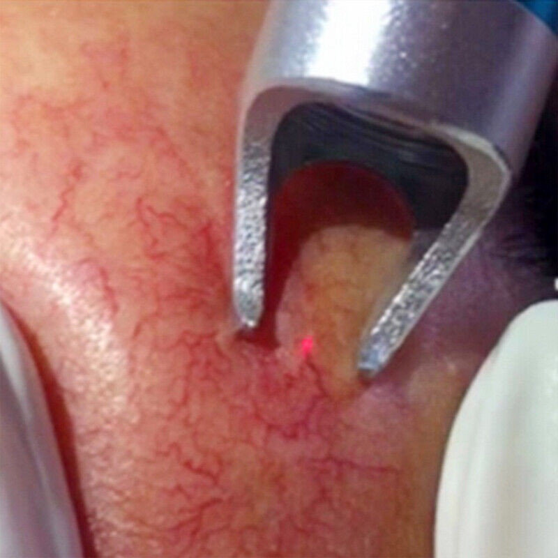 Professional 30W Laser Beauty Machine 980nm Diode Laser Spider Vascular Vein Removal