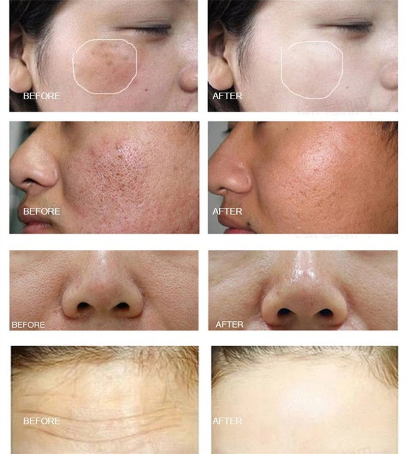 7 In 1 Portable Hydro Dermabrasion Machine Facial Cleansing