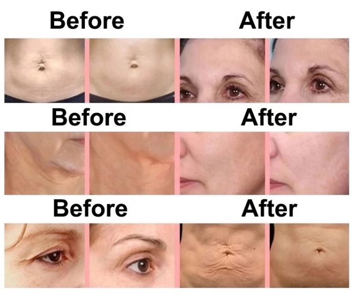 Best Thermagic Flx rf Skin Rejuvenation Machine For Rf Skin Tightening/ Face wrinkle removal