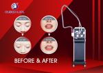 Medical Picosecond ND YAG Laser Machine Portable Tattoo Removal Machine