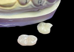Wholesale IPS e.max Ceramic Inlays and Onlays for Molar Restoration Natural Aesthetic and Superior Durability for Long-Lasting Results from china suppliers