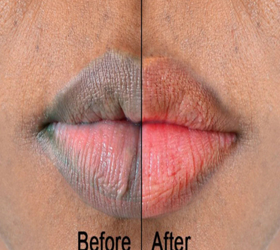 Stalideram Brand Pink Lip Injection Treatment Serum Derma Microneedling Mesotherapy Lip Repair Essence