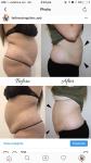 freezing cryo cool slimming machine