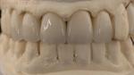 China Dental Lab Zirconia Full Contour Crown High Aesthetic Natural Dental