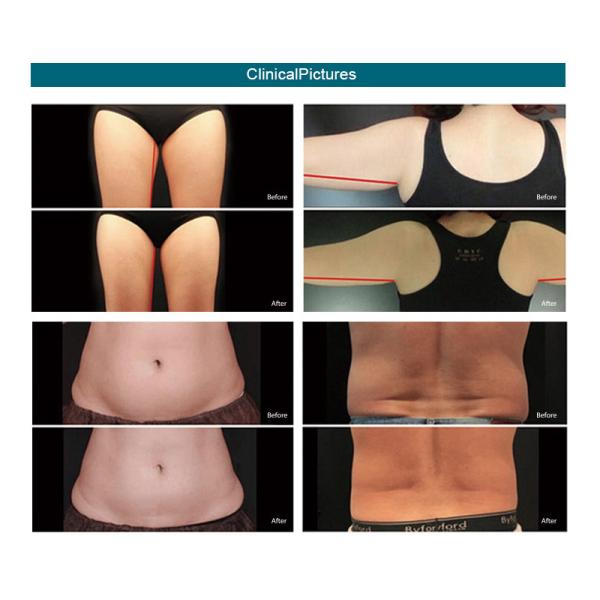 Professional Cryolipolysis Fat Freezing Machine Continuous Contact Cooling Beauty Machine