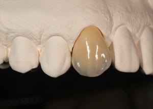 Wholesale Staining Resistance Solid Zirconia Crown for front teeth posterior teeth from china suppliers