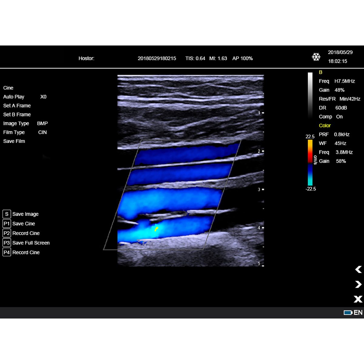 Color Doppler Portable Ultrasound Machine Medical USG PW CW DICOM Cardiac Probe Cardiology for Hospital Clinic