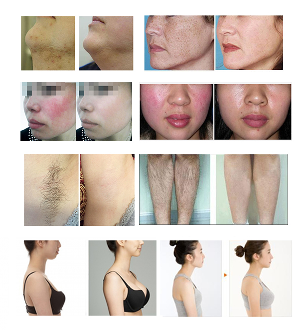 Hair Removal SHR IPL Machine 10.4" Color Touch Screen Display With Three Handpieces