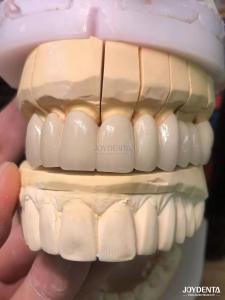 Wholesale Precision Fit Porcelain Fused to Metal PFM Crowns Seamless Natural Smile Enhancement from china suppliers