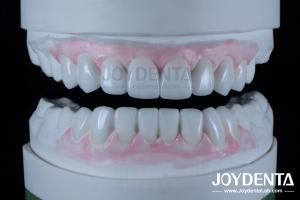 Wholesale Highly Accurate Dental Restorations Wax Up In Dentistry 1-2mm Thickness from china suppliers