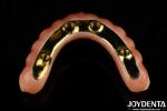 Dental Ti-Bar Hybrid Zirconia Bridge Excellent Strength Restores Chewing