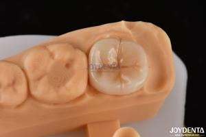 Wholesale 0.5mm-2mm Precise Fit Emax Dental Inlay Onlay For Reliable Tooth Restoration from china suppliers