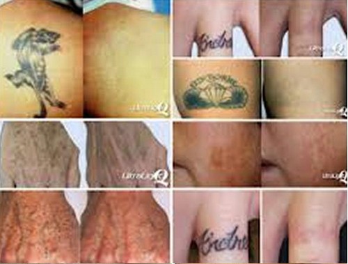 professional 1064nm&532nm 2014 new cheap q-switch laser tattoo removal machines