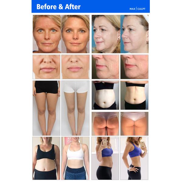VelaBody Vacuum Cavitation Slimming Radio Frequency Fat Reduction Machine Vacuum Weight Loss Body Contouring Machine