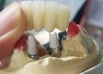 Strong Ti Base Milling Dental Implant Crowns Tooth Supported Bridge