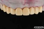 High Transparency PMMA Dental Material Natural Color Lifelike Aesthetics